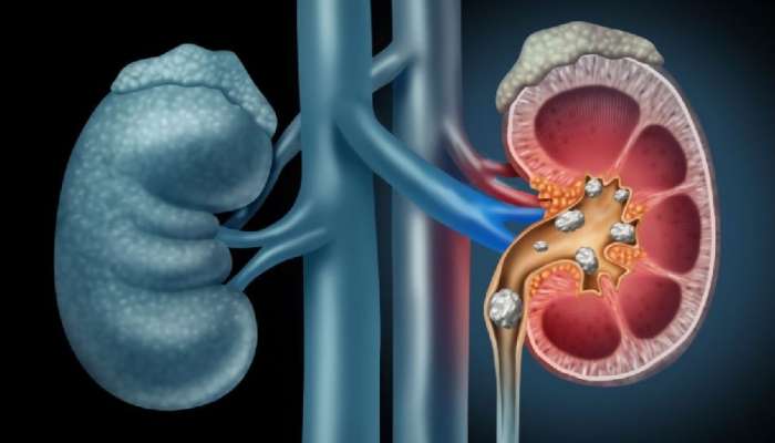 तुमच्या शरीरात असे बदल होत असल्यास वेळीस सावध व्हा, अन्यथा Kidney निकामी होऊ शकते