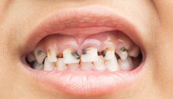 Herbal Tooth Powder: दात किडल्याची चिंता सतावतेय का? ही हर्बल पावडर घरीच बनवा आणि करा यातून सुटका 