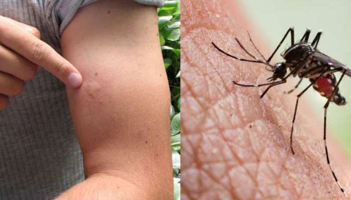 Mosquito bite : डास फक्त आपल्यालाच चावतात; असे तुम्हाला वाटते का? &#039;ही&#039; आहेत त्यामागची कारणे 