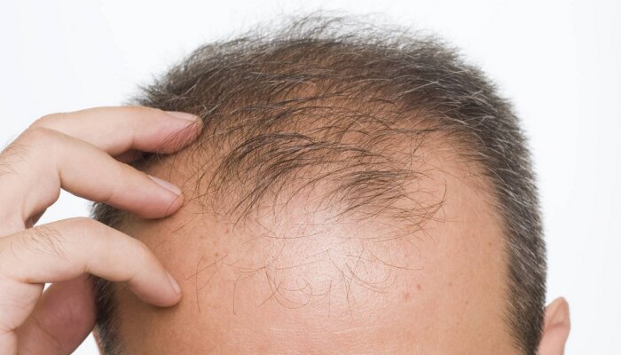 Hair Growth: टक्कल वाढतंय? &#039;या&#039; सवयी दूर करतील केस गळतीचा त्रास 