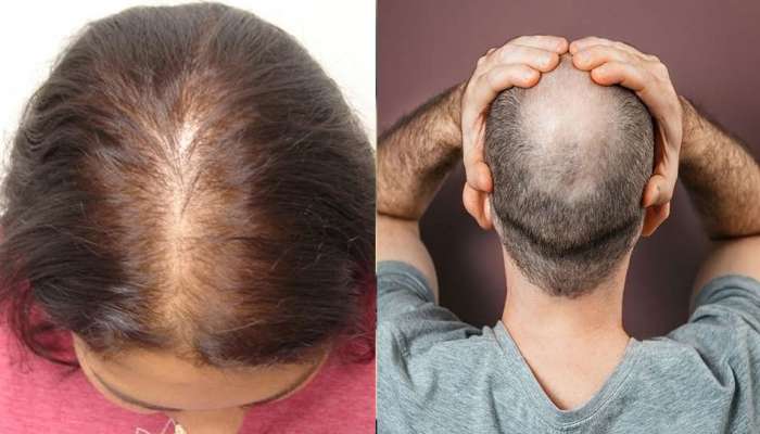 Hair Care: केस गळण्यासह टक्कल पडण्याची भीती, या पानाच्या मदतीने करा केस दाट आणि मजबूत