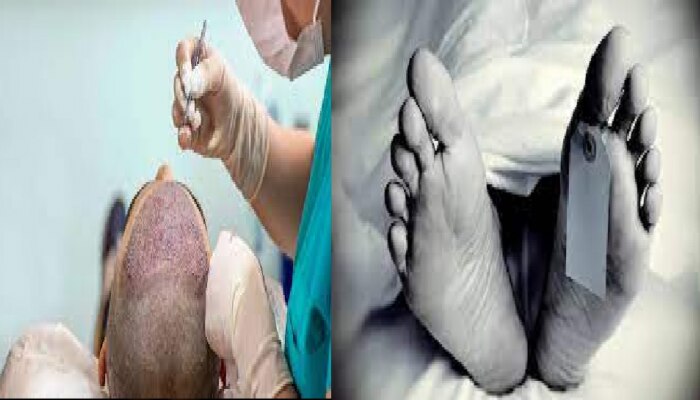 hair transplant death rate News in Marathi, Latest hair transplant death  rate news, photos, videos | Zee News Marathi