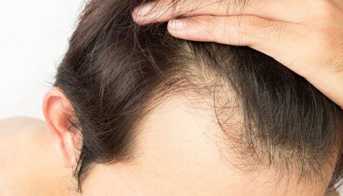 Hair Fall In Men: ...तर तुमचीही केस गळती थांबू शकेल, फक्त या गोष्टी पाळा  