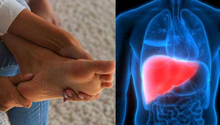 Liver Damage: तळहात आणि पायांना येतेय खाज, पैसे येणार नाहीत, लिव्हर आहे डॅमेज, डॉक्टरांना गाठा नाहीतर...