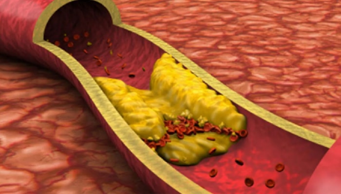 अशा 4 व्यक्तींच्या रक्तामध्ये वाढतं खराब cholesterol; आजच सावध व्हा!