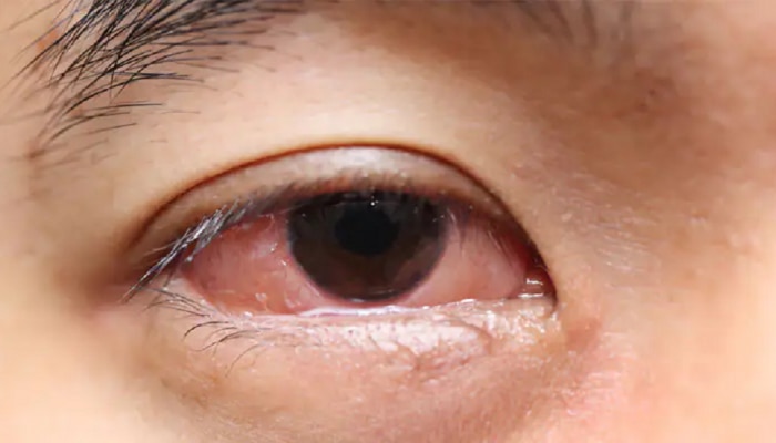 Swelling in Eyelids Causes:  तुमच्या ही पापण्या सुजतात का? जाणून घ्या कारणे आणि घरगुती उपाय...