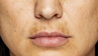 Dark Upper Lips: ओठांवरील काळे डाग नको असल्यास करा 'हे' घरगुती उपाय