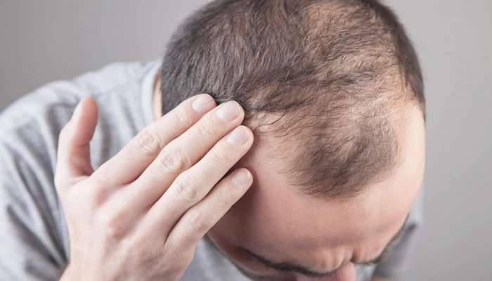 Hair Fall: तुमचेही सतत केस गळतात? आहारात करा 'या' गोष्टींचा समावेश, होतील फायदेच फायदे...