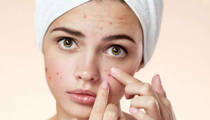 Pimples : पिंपल्सने तुम्ही त्रस्त असाल तर चुकूनही करु नका Mistakes, चेहऱ्याला पोहोचू शकते मोठे नुकसान
