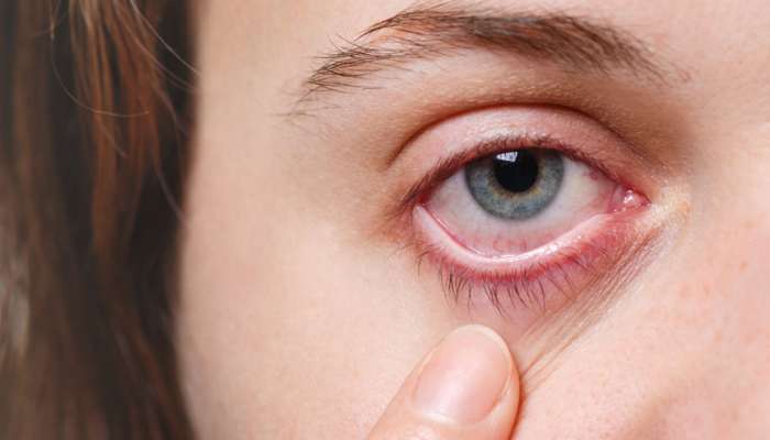Dry Eye: डोळे कोरडे आणि निस्तेज दिसत असतील तर आताच व्हा सावधान, या मोठ्या समस्यांना द्यावे लागू शकते तोंड 