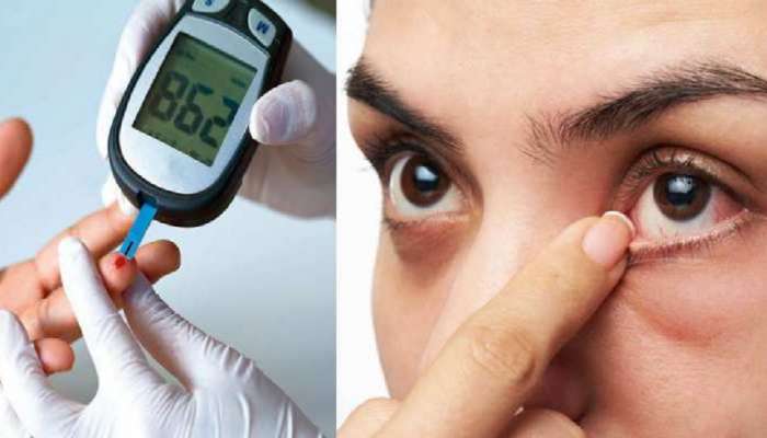 Type 2 Diabetes ची ही 5 सुरुवातीची लक्षणे तात्काळ ओळखा, अन्यथा मोठा लॉस  
