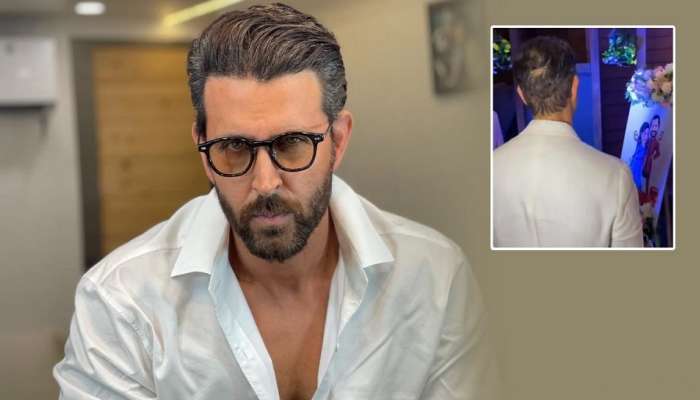 Celebrity Hair Transplant  Bollywood Celebrity Before After