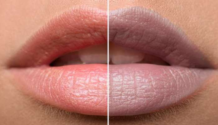  Dark Lips Remedy: ओठांचा काळेपणा दूर करायचाय, जाणून घ्या 