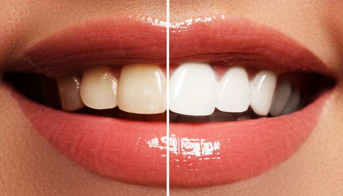Bye Bye Yellow Teeth : या फळाच्या सालीचा वापर करून दात चमकतील मोत्यासारखे, फक्त असा करा वापर...