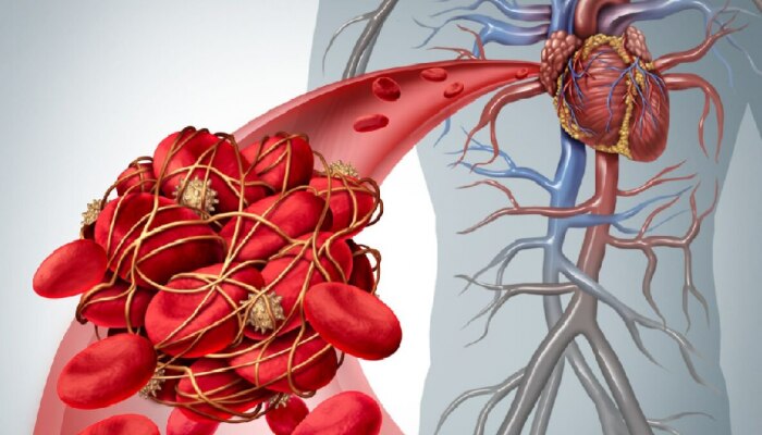 &#039;या&#039; कारणामुळे हृदयात होतायत blood clots; शरीरात दिसून येतील &#039;ही&#039; लक्षणं