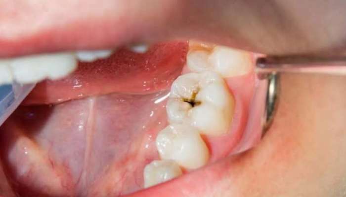 Cavity वर रामबाण उपाय &#039;या&#039; घरगुती गोष्टींमुळे दात होतील चकाचक