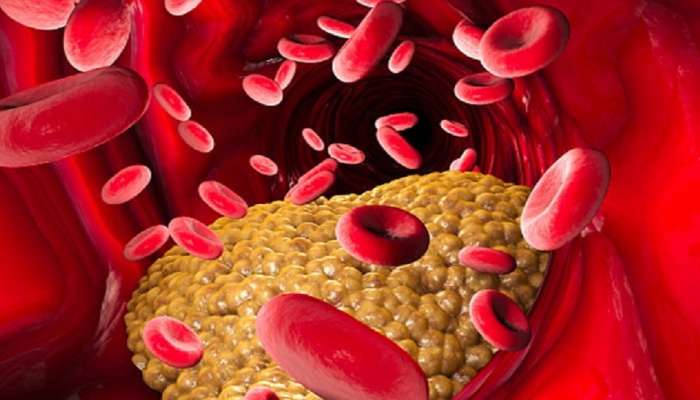 High Cholesterol Symptoms : हाय कोलेस्ट्रॉल वाढण्याची &#039;ही&#039; आहेत लक्षणे,जाणून घ्या