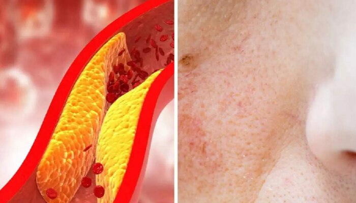 High cholesterol : कोलेस्ट्रॉल वाढल्यावर तुमच्या त्वचेवर होतात &#039;हे&#039; 3 बदल!