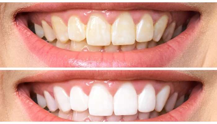 Yellow Teeth: पिवळे दात चमकवण्यासाठी घरगुती उपाय, काही दिवसात दिसेल फरक