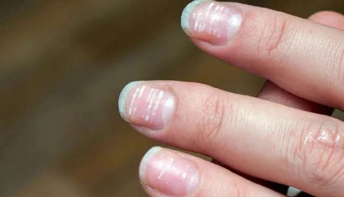 White spots on nails: नखांवर पांढरे डाग आल्यास दुर्लक्ष करु नका? या गंभीर आजाराचे देतात संकेत