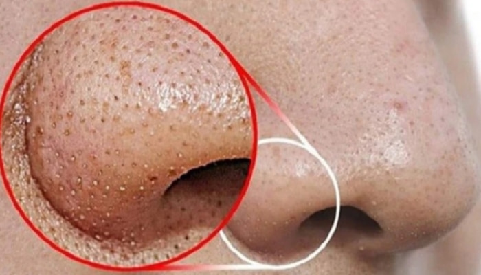 Skin Care Tips: ब्लॅक हेड्सच्या त्रासाला कंटाळलात..करून पाहा हे उपाय..मिळवा सुंदर त्वचा.. 