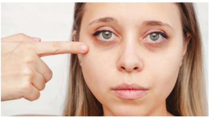 Dark Circles: Stress आणि कमी झोपेमुळे झालेत Dark Circle? मग करा हे उपाय