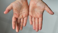 Measles Outbreak: लहान मुलांसह प्रौढांनाही गोवरची लागण? 2 संशयित रुग्ण आढळले!