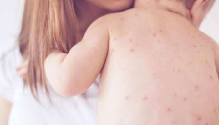 Measles Outbreak in Mumbai: मुंबईत गोवरचं थैमान! सव्वा वर्षाच्या मुलीचा मृत्यू, धक्कादायक माहिती समोर