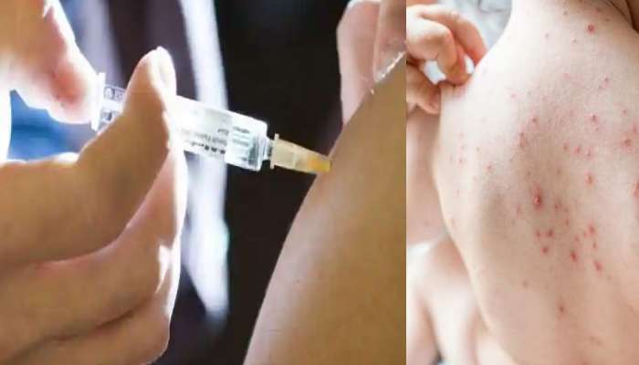 Measles spread : मुंबईनंतर आता नाशिक जिल्ह्यात गोवरने हातपाय पसरलेत, रुग्ण आढळल्याने आरोग्य विभाग अलर्टवर