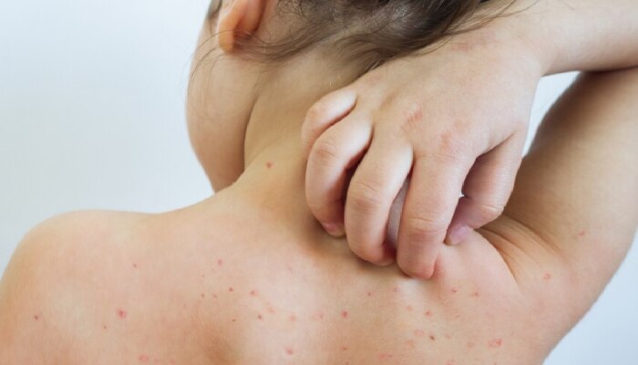 Measles : गोवरचं थैमान! 8 महिन्यांच्या बाळाचा उपचारादरम्यान मृत्यू