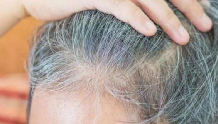 White Hair Solutions: कमी वयात केस पांढरे झाले? &#039;हे&#039; 4 घरगुती उपाय केल्यास होतील काळेभोर केस