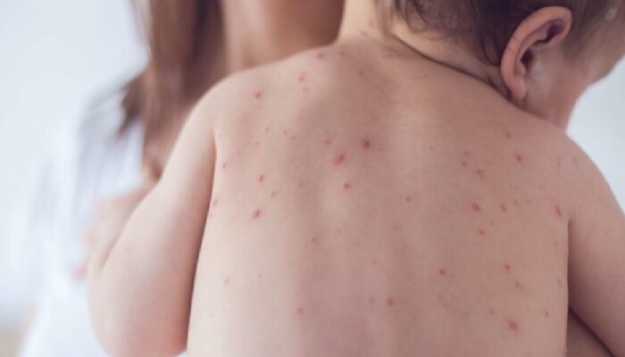 Measles Outbreak : गोवरचा आणखी एक बळी; गोवंडीत 8 महिन्यांच्या मुलाचा मृत्यू