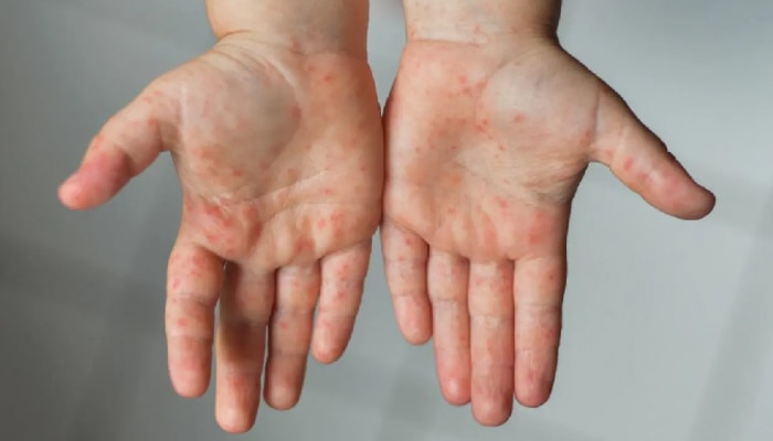 Measles Outbreak : तुमच्या मुलांना जपा! आगामी 4 महिन्यात गोवरच्या रूग्णांची संख्या वाढण्याची शक्यता