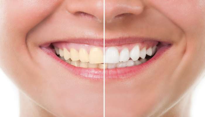 Teeth Whitening : पिवळे दात होतील चकाचक, &#039;या&#039; घरगूती टीप्स वापरून पाहा  