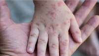 Monkeypox संदर्भात WHO चा मोठा निर्णय; संपूर्ण जगाला उद्देशून सांगितलं... 