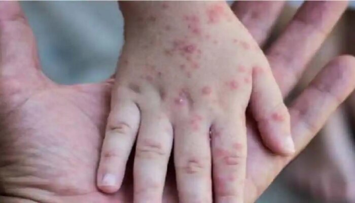 Monkeypox संदर्भात WHO चा मोठा निर्णय; संपूर्ण जगाला उद्देशून सांगितलं... 