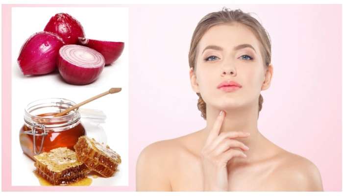 Beauty Remedies: कांद्यामध्ये ही वस्तू मिसळून लावा, त्वचेच्या समस्या दूर होतील; शिवाय ग्लो येईल