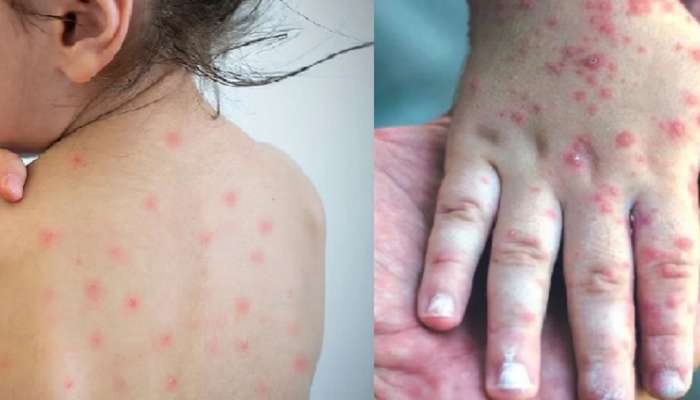 Measles Outbreak : राज्यात 34 ठिकाणी गोवरचा उद्रेक, कोरोनापेक्षा पाच पट वेगाने पसरतोय