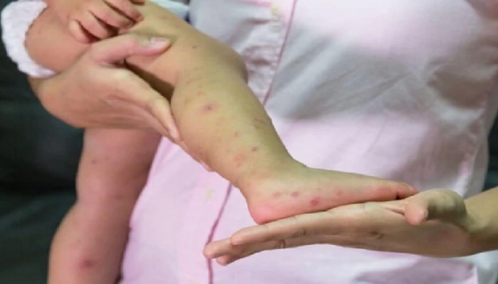 Measles : गोवरचा कोरोनापेक्षा पाचपट वेगानं फैलाव?