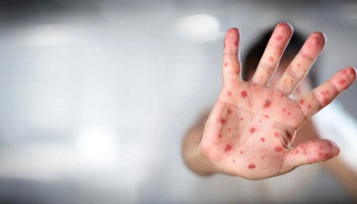 Measles Outbreak: गोवरचा प्रसार रोखण्यासाठी राज्य सरकार लागलं कामाला, असा आहे Action Plan