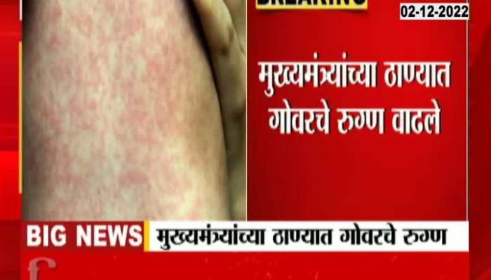 Measles patients increased in Chief Minister's station, how to prevent measles?