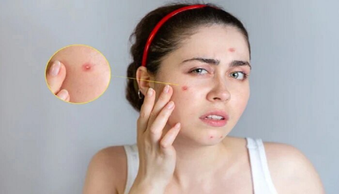 pimples: या गोष्टींमुळे येतात चेहऱ्यावर पिंपल्स...अजिबात खाऊ नका...