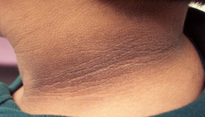 Dark Neck:  मानेवरचा काळपट थर असा करा दूर...केवळ 10 रुपयात होईल काम 