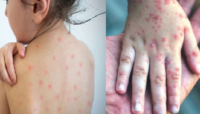 Govar Rubella Vaccination : कोरोनानंतर आता गोवरशी लढा, पाहा कोणासाठी लस अतिशय महत्त्वाची 