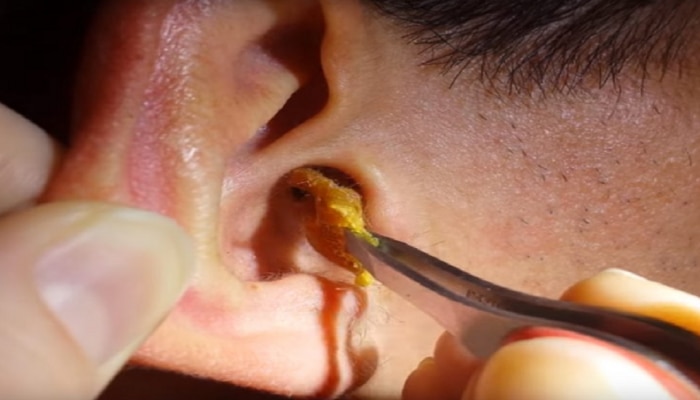 Earwax hacks : कानात मळ साठलाय...हे घ्या कान साफ करण्याचे सोपे उपाय...