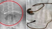 भयंकर पोटात दुखलं,भडाभड उलट्या झाल्या; 15 वर्षाच्या मुलाचा X-ray पाहून डॉक्टर हादरले