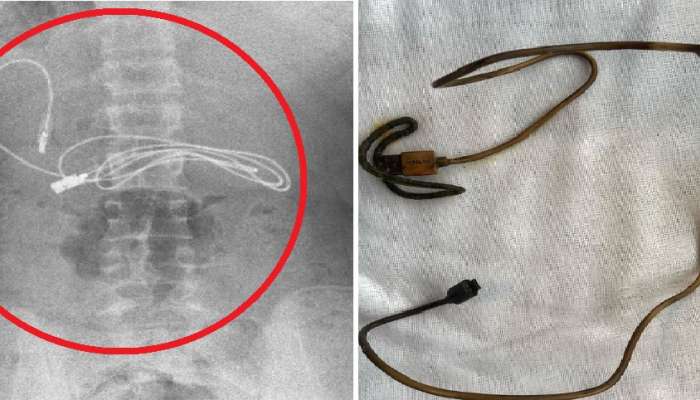 भयंकर पोटात दुखलं, भडाभड उलट्या झाल्या; 15 वर्षाच्या मुलाचा X-ray पाहून डॉक्टर हादरले 