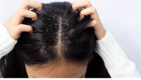 dandruff treatment : डोक्यात कोंडा झालाय खाज सुटलीये? हा उपाय एका आठवड्यात करेल काम.