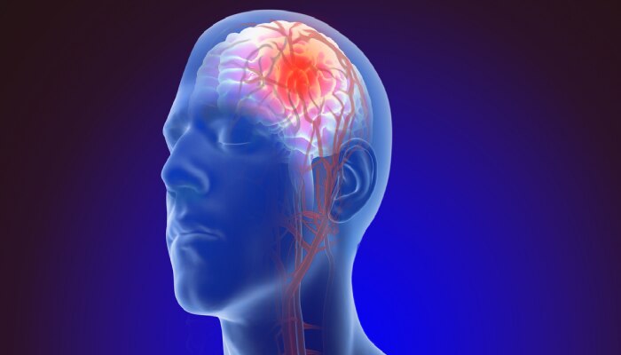 काय आहेत Brain Aneurysm लक्षणं;  पाहा कशी उद्भवते धोकादायक परिस्थिती?