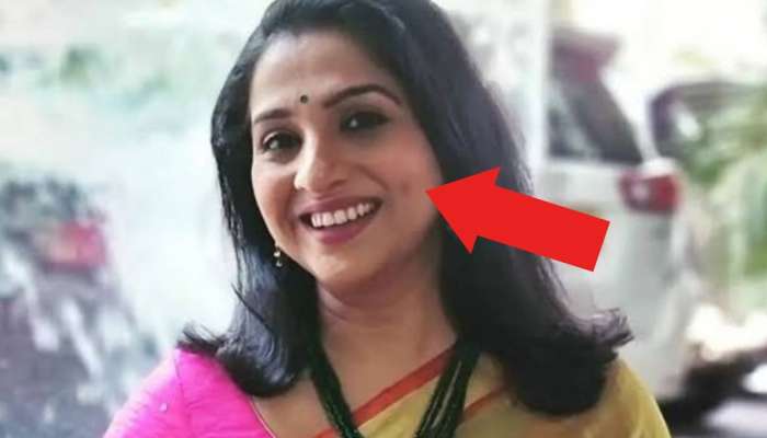 गालावरची खळी हा एक भयानक आजार; मधुराणी प्रभुलकरचा मोठा खुलासा